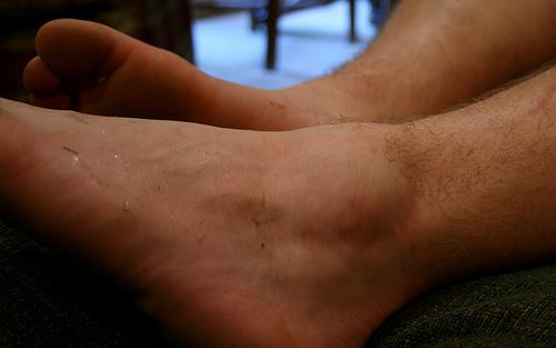 Swollen Ankle No Pain: 7 Possible Causes and 8 Home Remedies | New